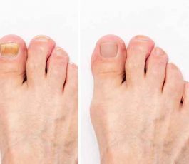 How to prevent toenail fungus?